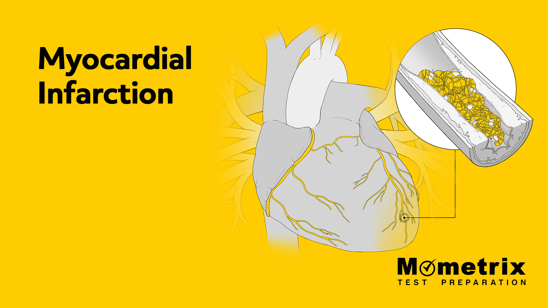 myocardial-infarction-c3a